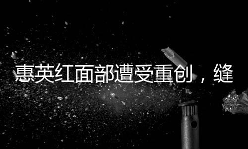 惠英红面部遭受重创，缝针达89次——演艺界的坚韧之星