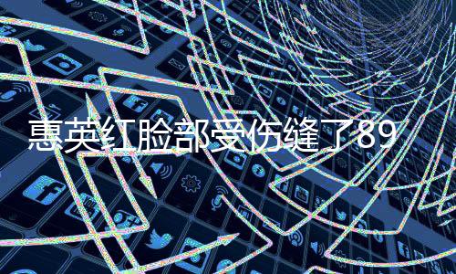 惠英红脸部受伤缝了89针，经历令人震惊