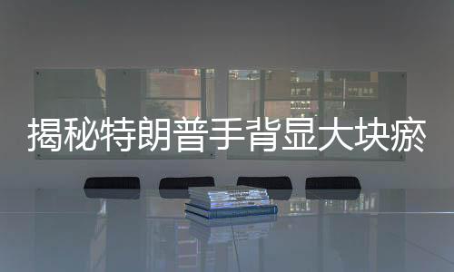 揭秘特朗普手背显大块瘀伤，握手太多还是另有原因？