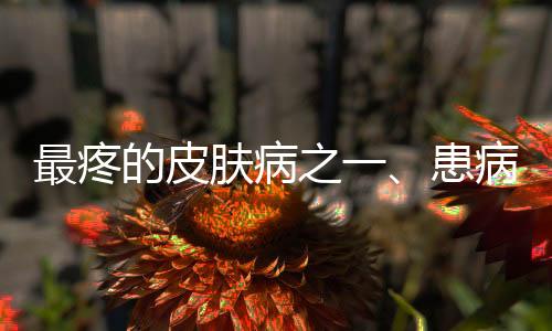 最疼的皮肤病之一、患病率高达三分之一的肌肤之痛