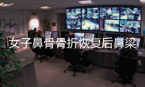 女子鼻骨骨折恢复后鼻梁提升，重拾自信美丽