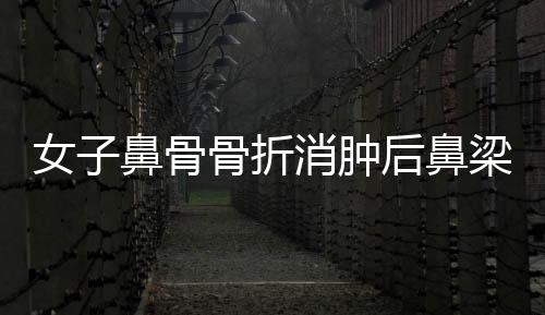 女子鼻骨骨折消肿后鼻梁高挺，重拾自信美