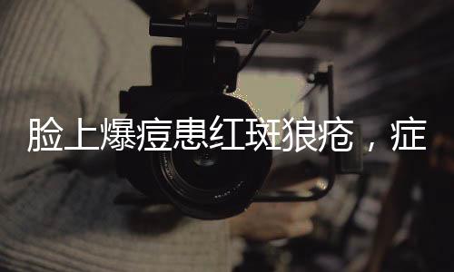 脸上爆痘患红斑狼疮，症状解析与应对之道